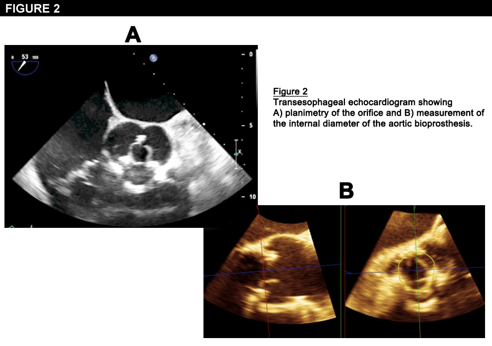 Figure 2: Concomitant Transcatheter Aortic and Mitral Valve-in-Valve Replacements Using Transfemoral Devices Via the Transapical Approach: First Case in the U.S.