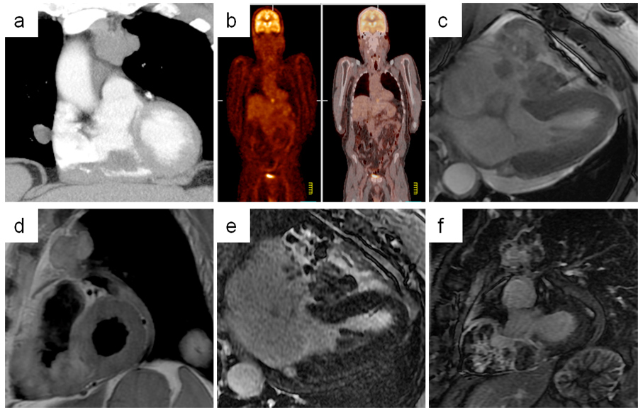 Figures A-F: MRI for Assessment of a Cardiac Mass