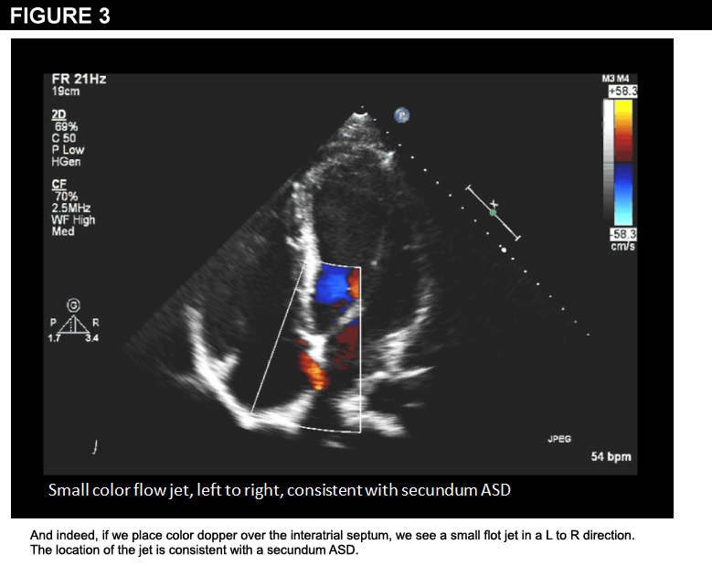 NCAA Freshman Basketball Player With Atrial Septal Defect (ASD ...