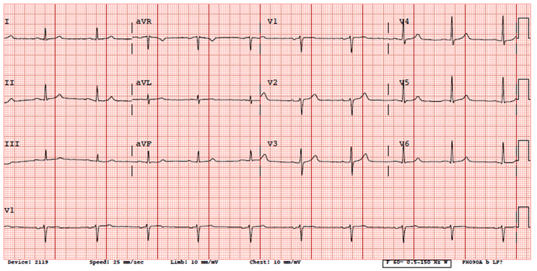 Electrocardiogram: Treating a 47 Year-Old Male With Lymphoma and Shortness of Breath