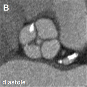 Figure B: Unexpected Finding on Cardiac CT Before TAVI