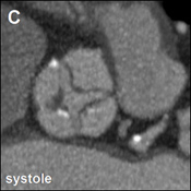 Figure C: Unexpected Finding on Cardiac CT Before TAVI