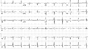 Twenty-four hour Holter recording is ordered, and reveals daytime normal sinus rhythm with rare premature ventricular contraction, and an approximately four-hour night-time change in rhythm (between 3:35AM and 7:52AM). A brief tracing from the period of altered rhythm is shown below (recorded at 5:41:47AM).