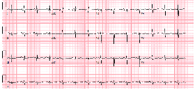 Figure 1: Baseline EKG showing normal sinus rhythm