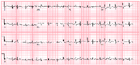 Figure 2: EKG showing the development of atrial fibrillation with occasional PVC's
