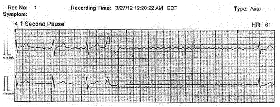 Figure 4: Remote monitoring showing a 4.1 second pause during sleep