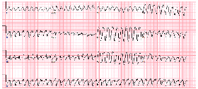 Figure 5: Wide complex tachycardia leading to cardiac arrest