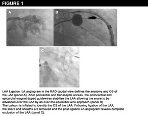 Figure 1: Left Atrial Appendage Exclusion Devices – Where Are They Going