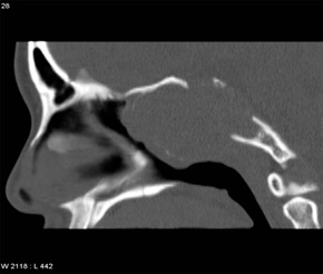 Figure 1: Which CV Patients Suffering From Sleep Apnea May Be Candidates for Surgical Treatment