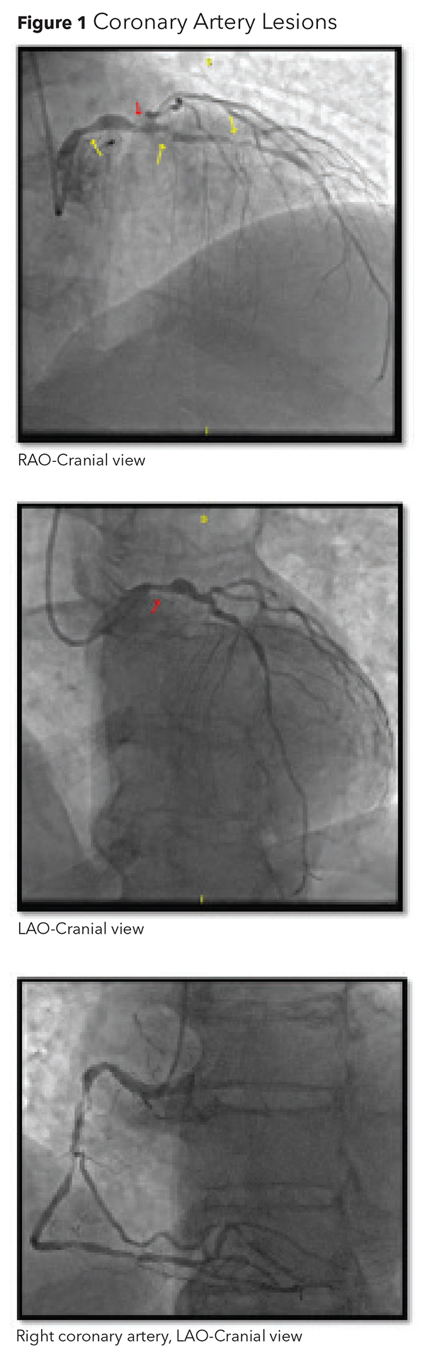 Left Main Revascularization - Primer For Early Career Cardiologists
