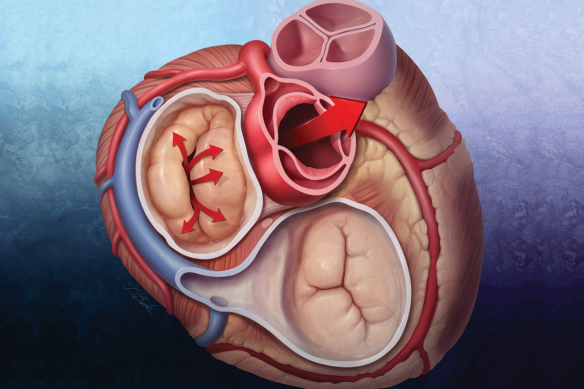 Cover Story | Secondary Mitral Regurgitation: When to Refer, When to Treat and How to Treat?