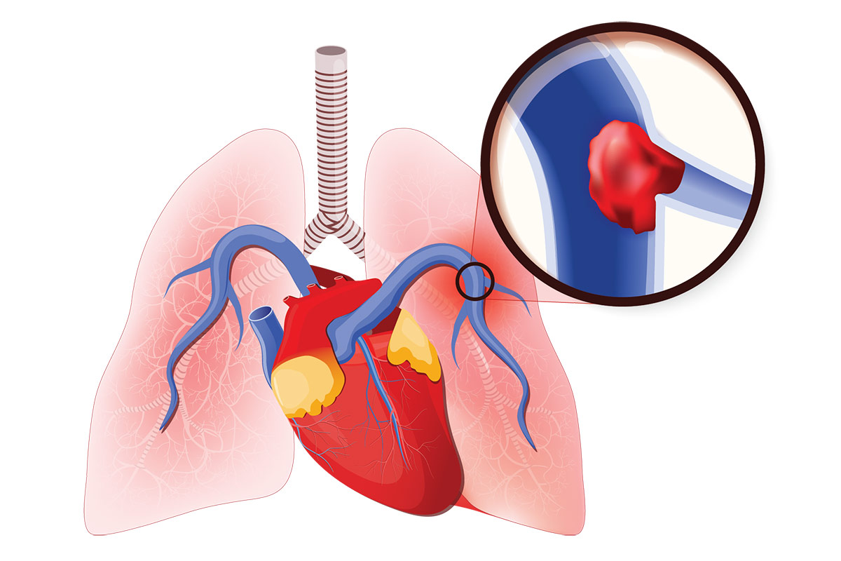 Transforming Acute PE Care: Standardizing Management to Improve Outcomes