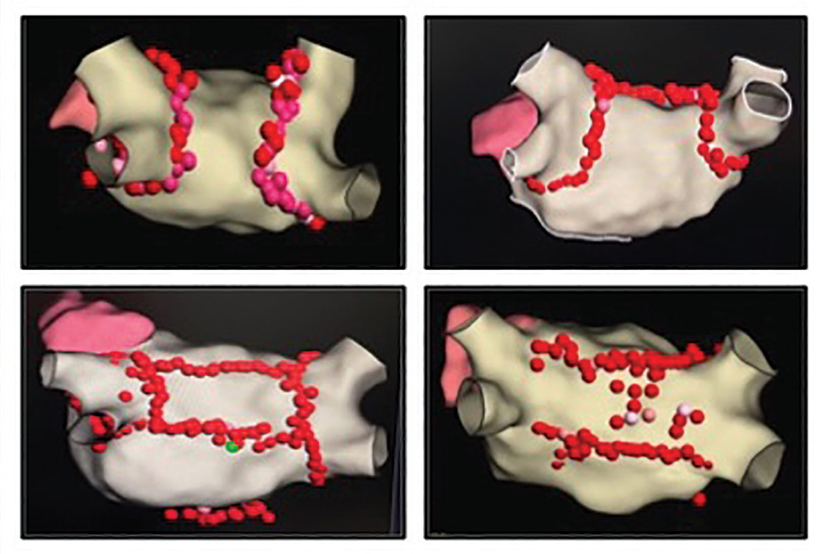 The Art of Atrial Fibrillation Ablation