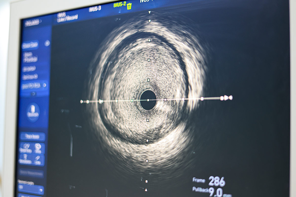 Intravascular Imaging; Conceptual Image