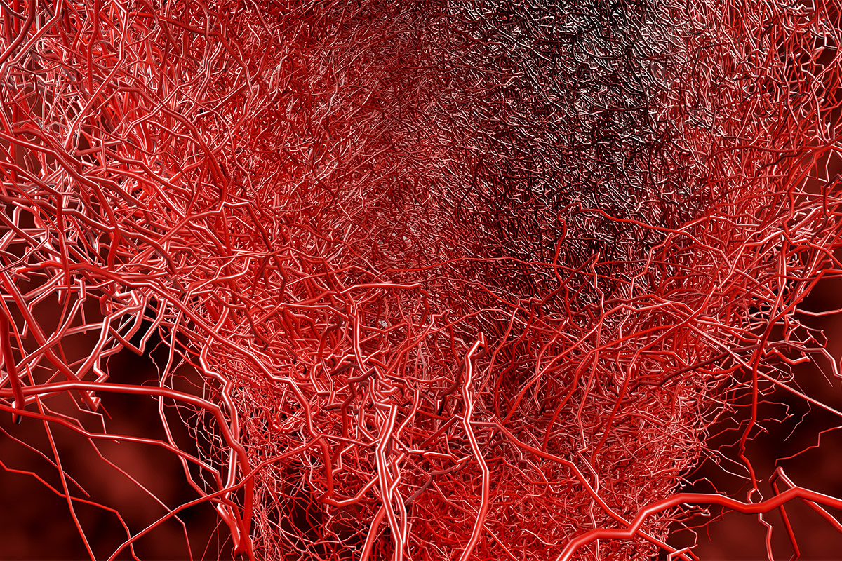 Limitations of PCI in Patients With Small Vessel Disease