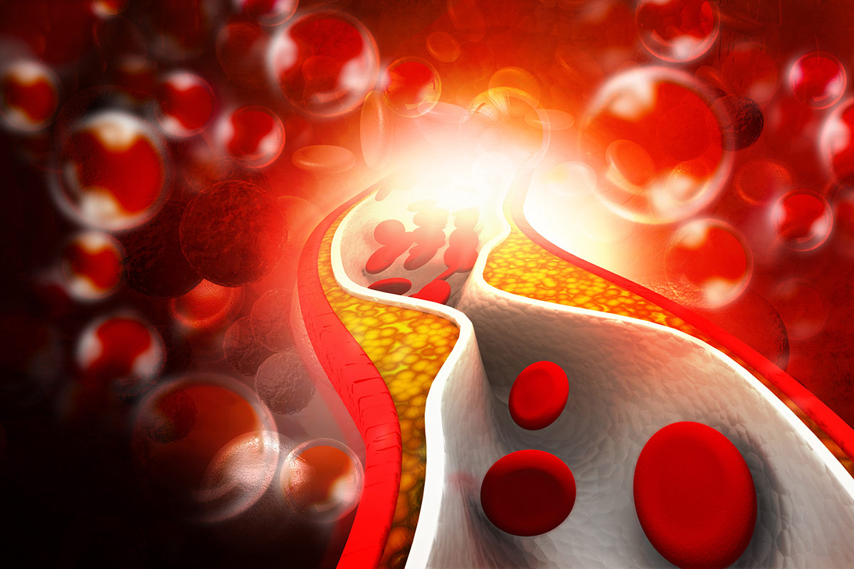 New in Clinical Documents | New Guidance For Nonstatin Therapies to Manage LDL-C in ASCVD