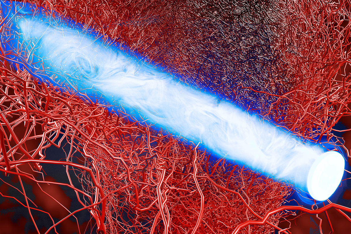 Spotlight Series | Microvascular Dysfunction Treatment Options For Coronary Microvascular Dysfunction