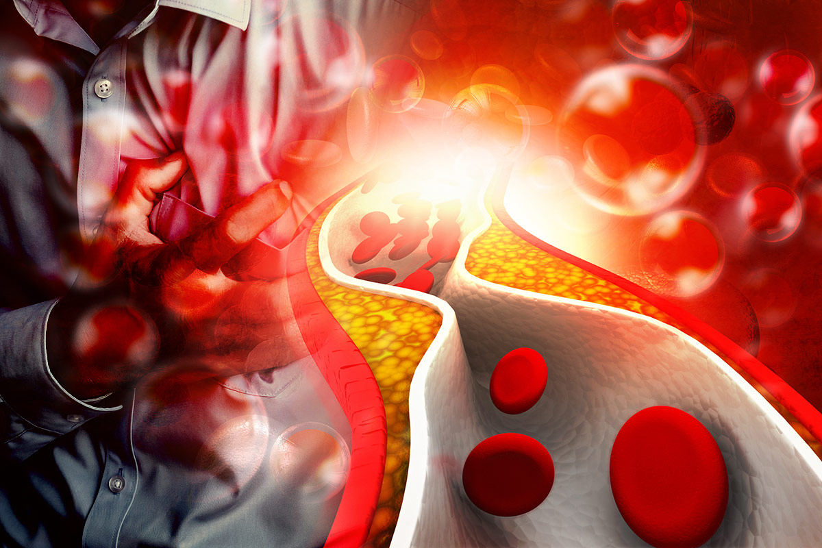 ACC Expert Consensus Decision Pathway: Integrating ASCVD and Multimorbidity Treatment