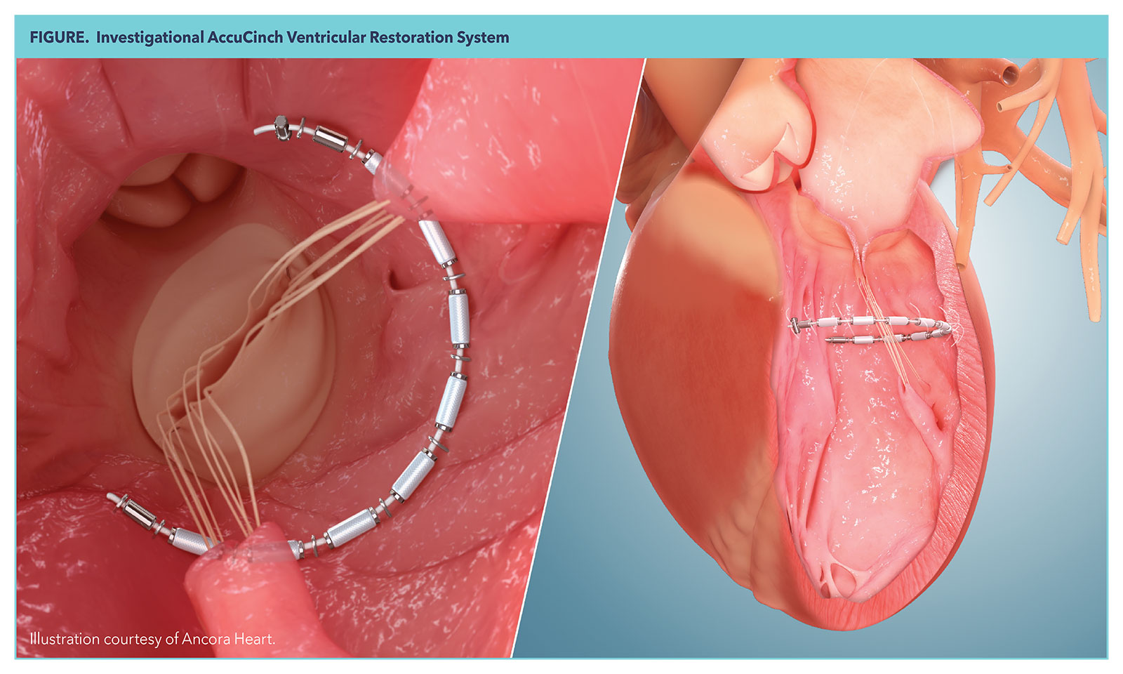 Structural Heart Intervention: A Peek at the Future