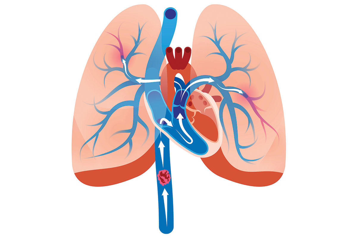 Peripheral Matters | Inferior Vena Cava Filter Retrieval: Update on Advanced Techniques