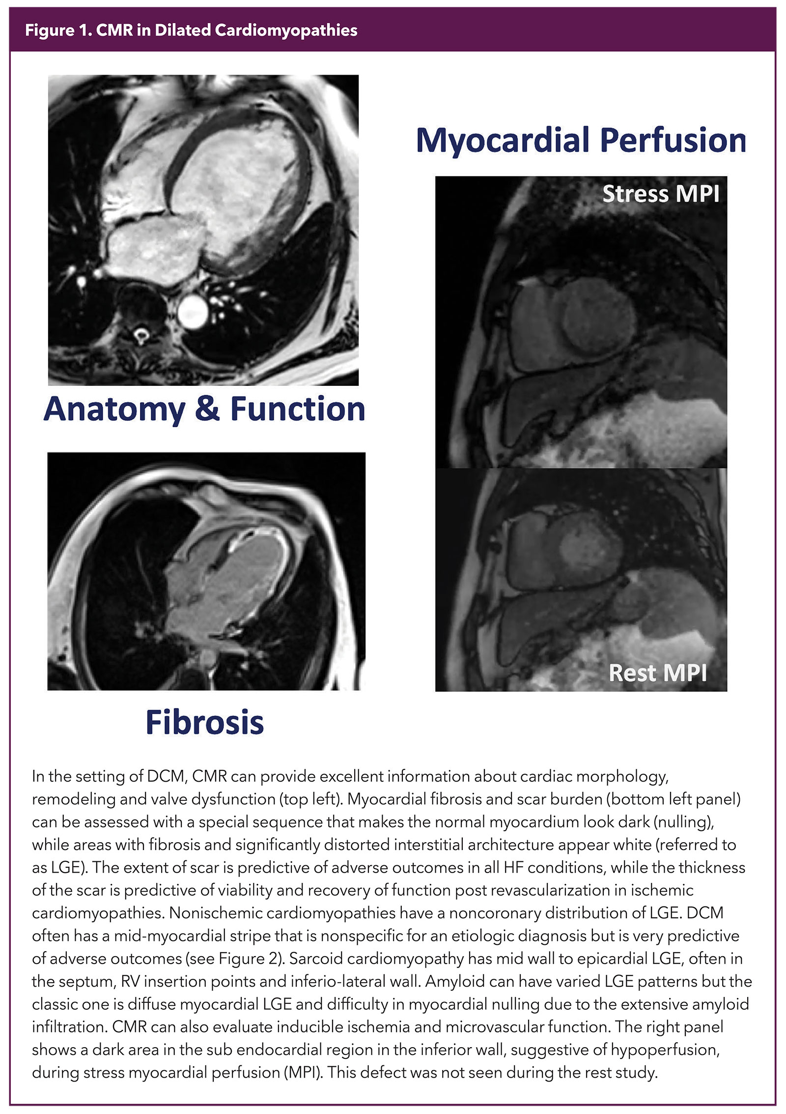 Advanced Imaging in Cardiomyopathies