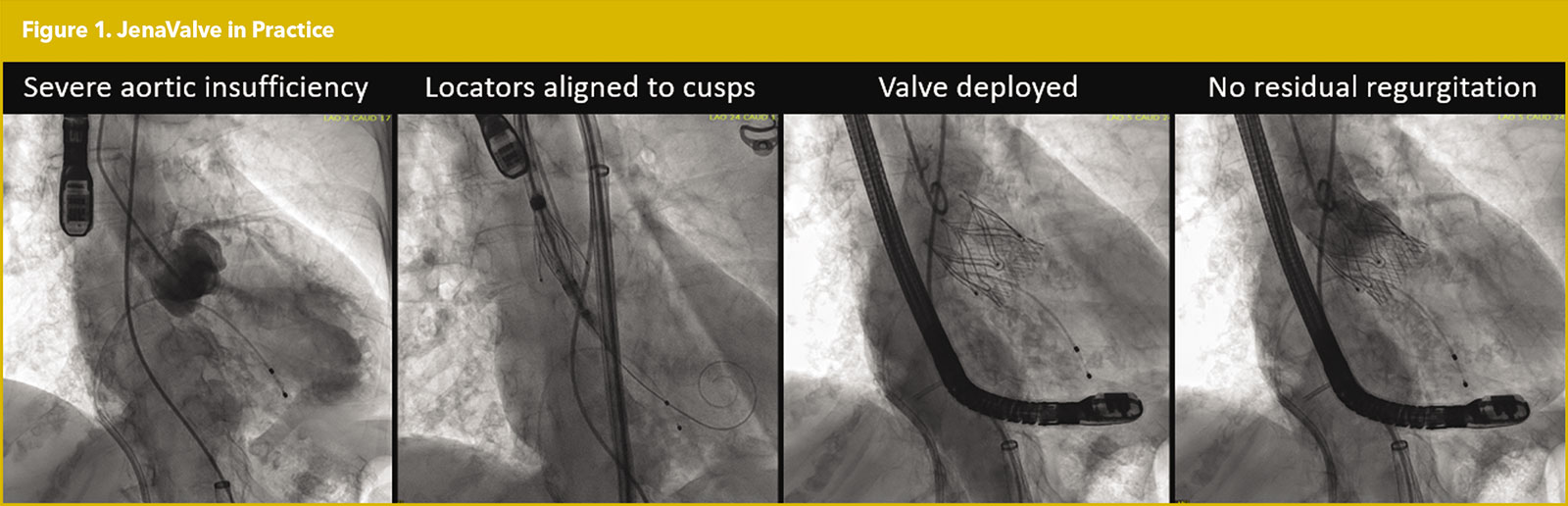 Transcatheter Aortic Valve Replacement 
For Pure Native Aortic Insufficiency