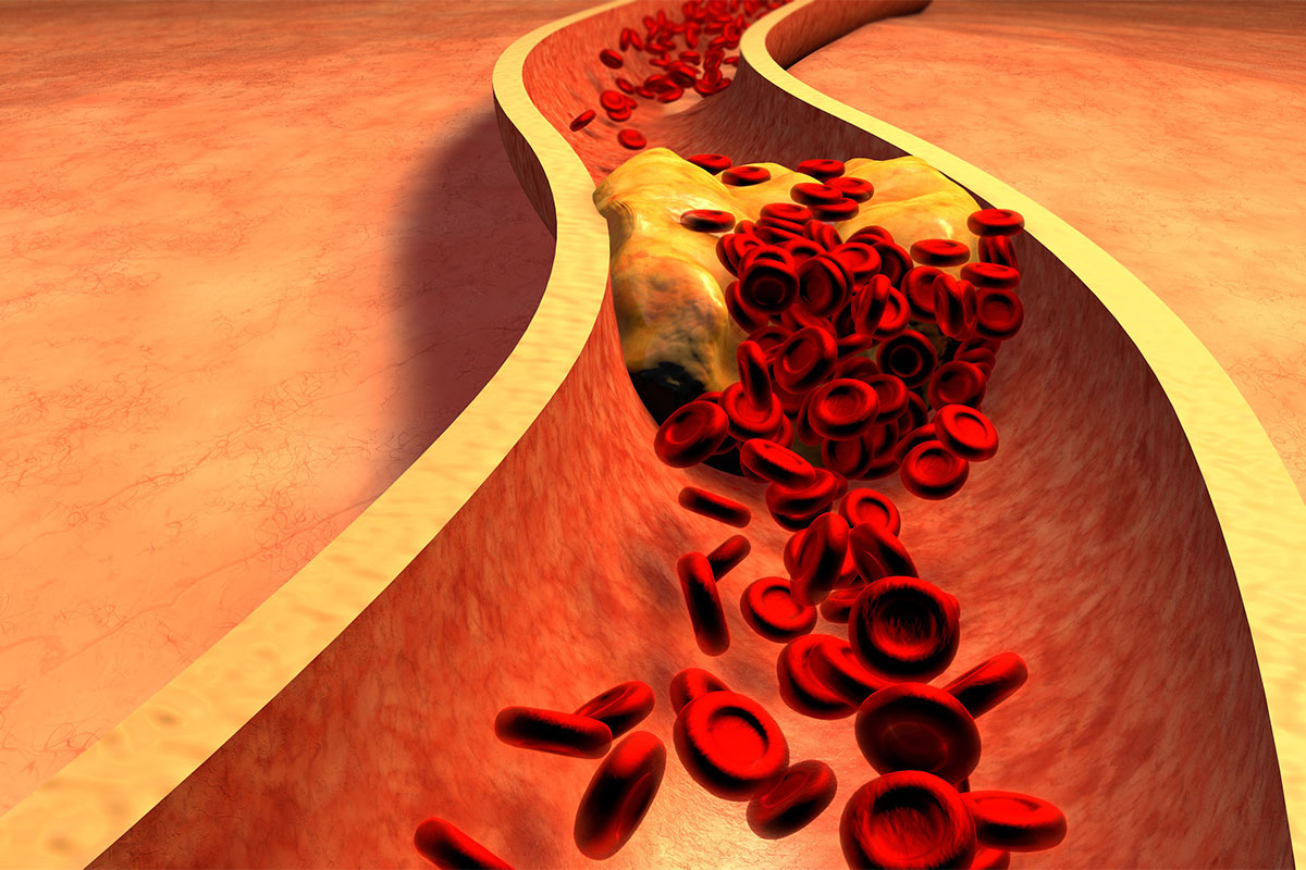 Peripheral Artery Disease: Moving From Awareness to Action