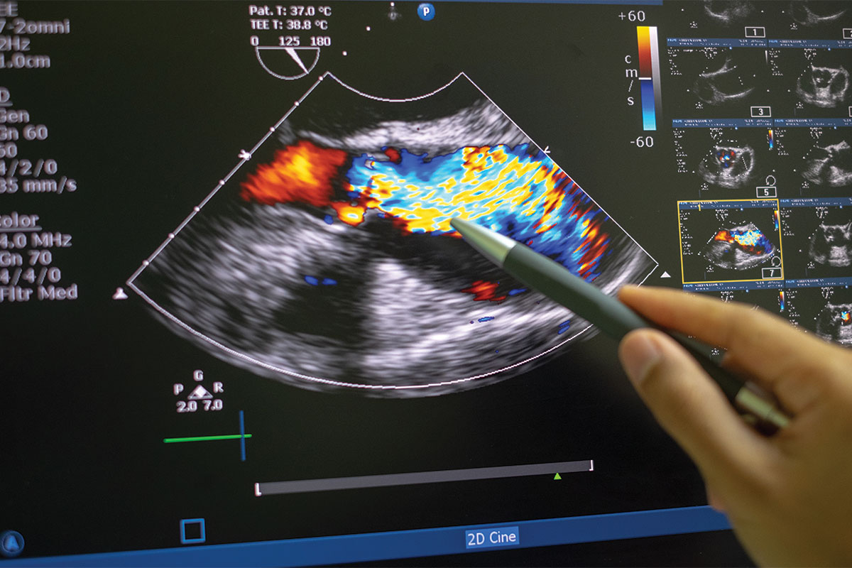 TAVR in Asymptomatic and Moderate AS