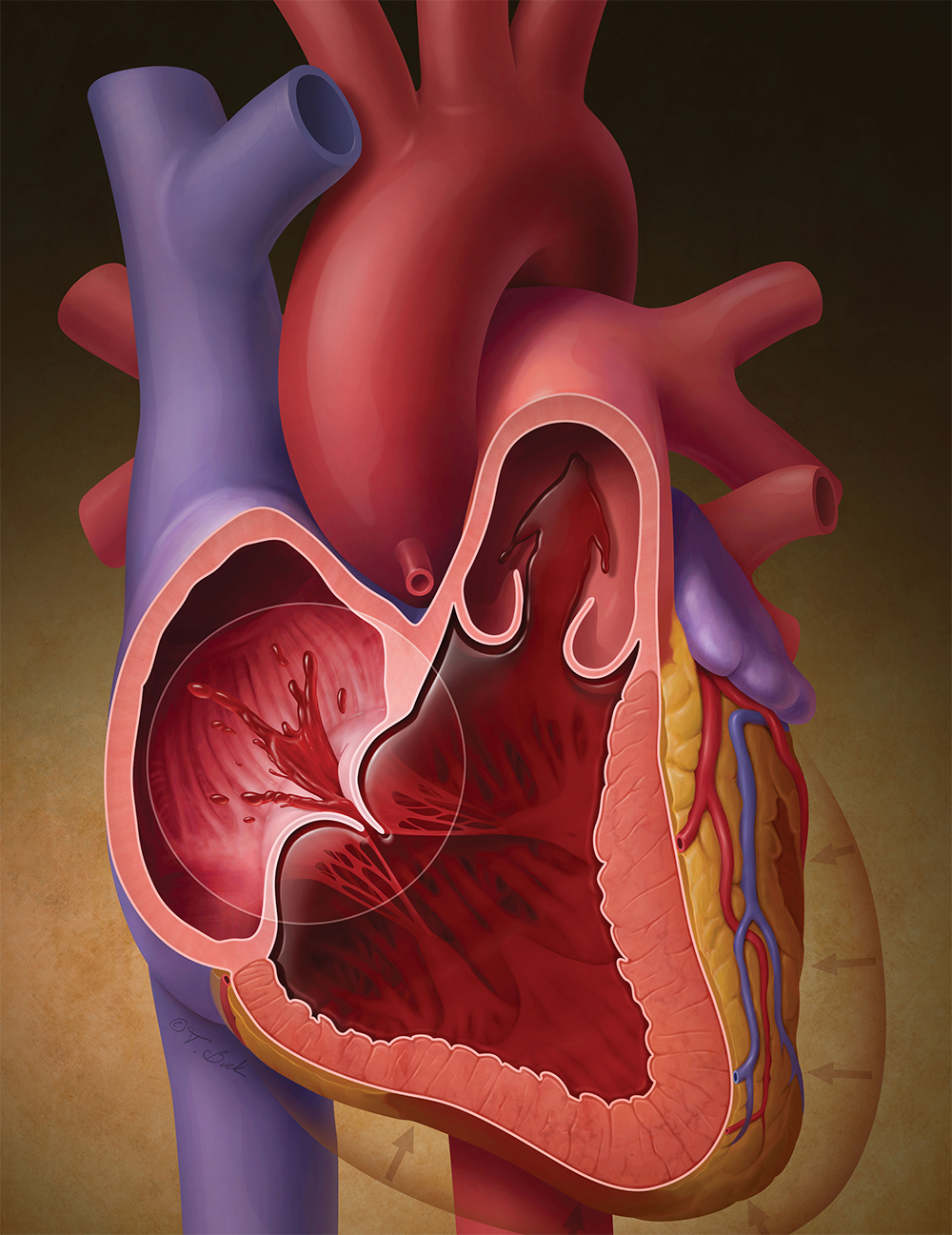 Tricuspid Valve Intervention: Clinical Decision-Making For Patient Selection