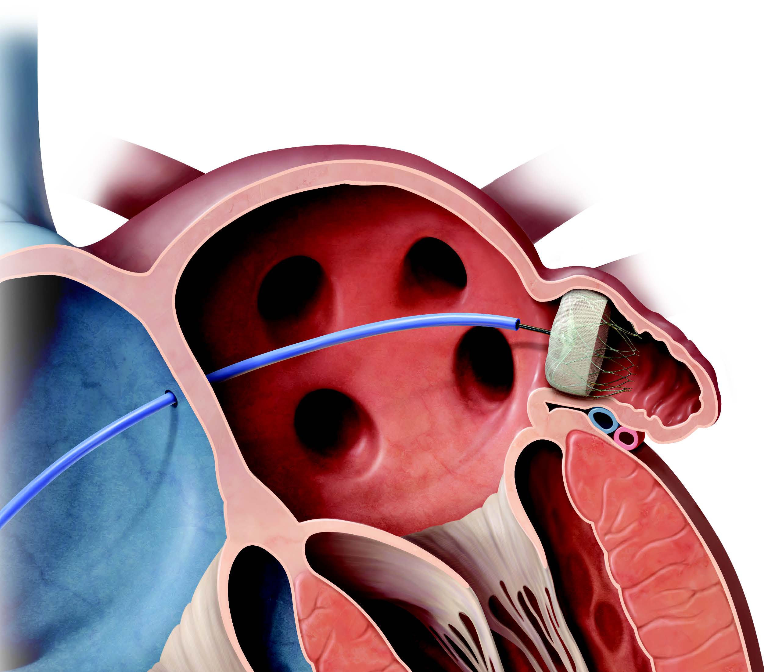 Stroke Prevention in AFib: Defining the Role of LAAO
