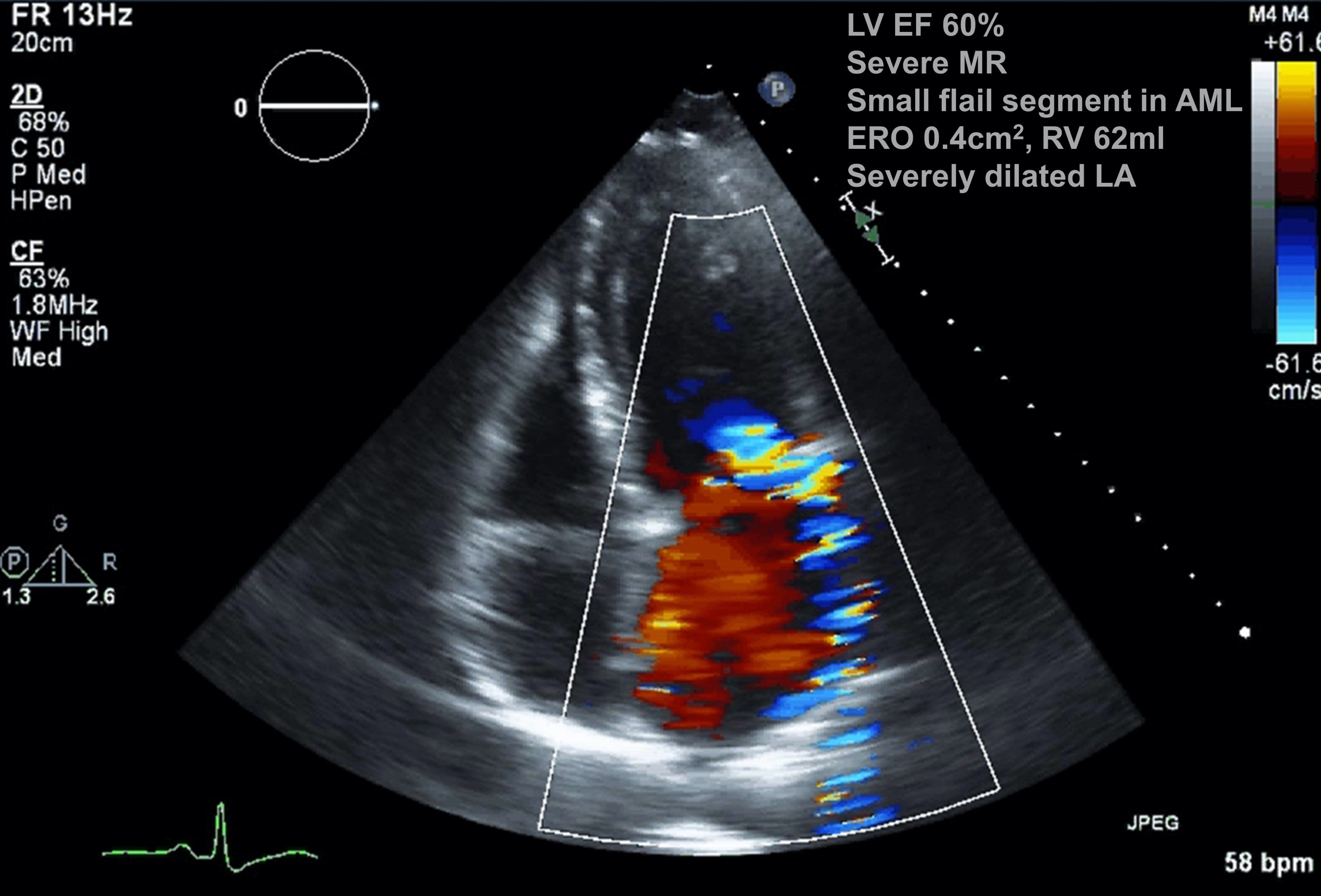 Echocardiography (Diastolic function & dysfunction) - TECHmED