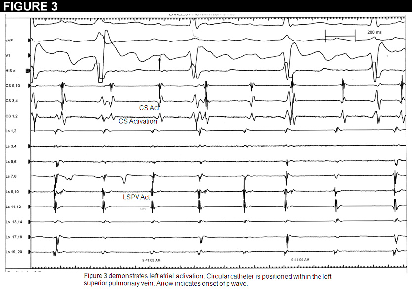 Figure 3: Atrial Fibrillation as a Cardiomyopathy Equivalent?