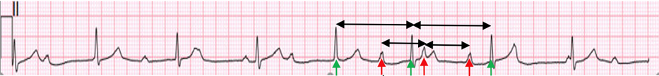 Figure 1: ECG Lead II Showing P Waves With a Regular Interval