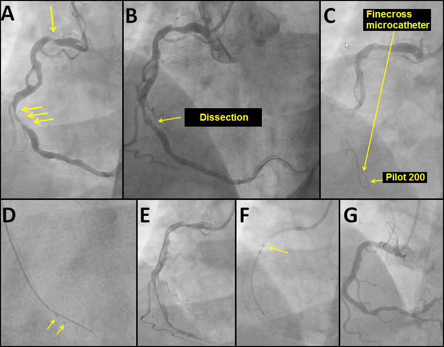 Figures A- G: Dissected the Coronary and Lost Wire Position: What to Do Next?