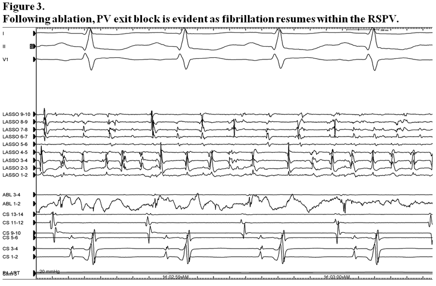 Figure 2D:A 71-Year-Old Man With Recurrent AFib After Prior Ablation