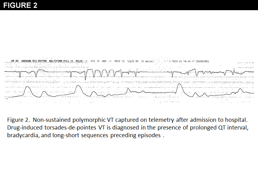 Figure 2:A 64-Year-Old Woman With Atrial Fibrillation and Syncope