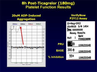 Figure 2: 8h Post-Ticagrelor (180mg) Platelet Function Results