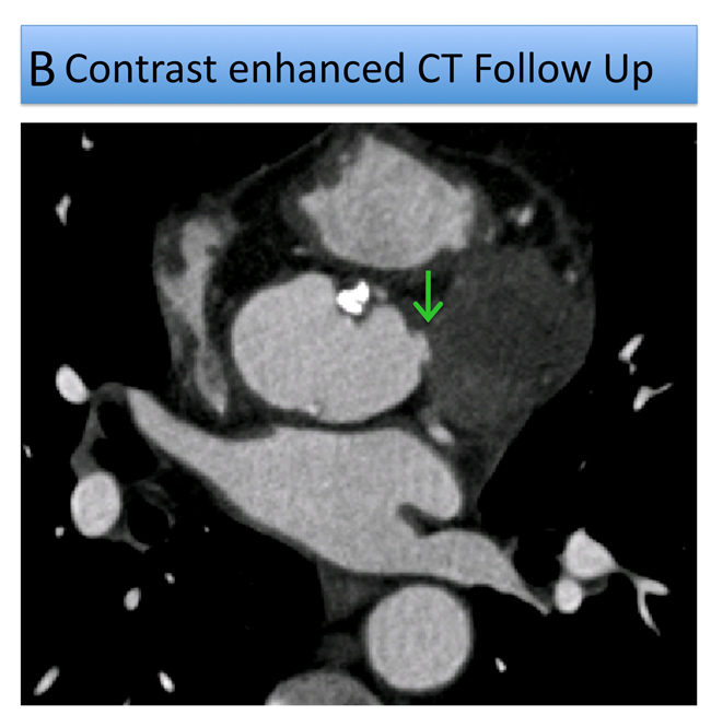 Figure b: A 58-Year-Old Man Presents With Anterior NSTEMI
