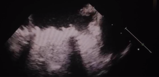 Thrombosed Mechanical Mitral Valve in a Pregnant Patient