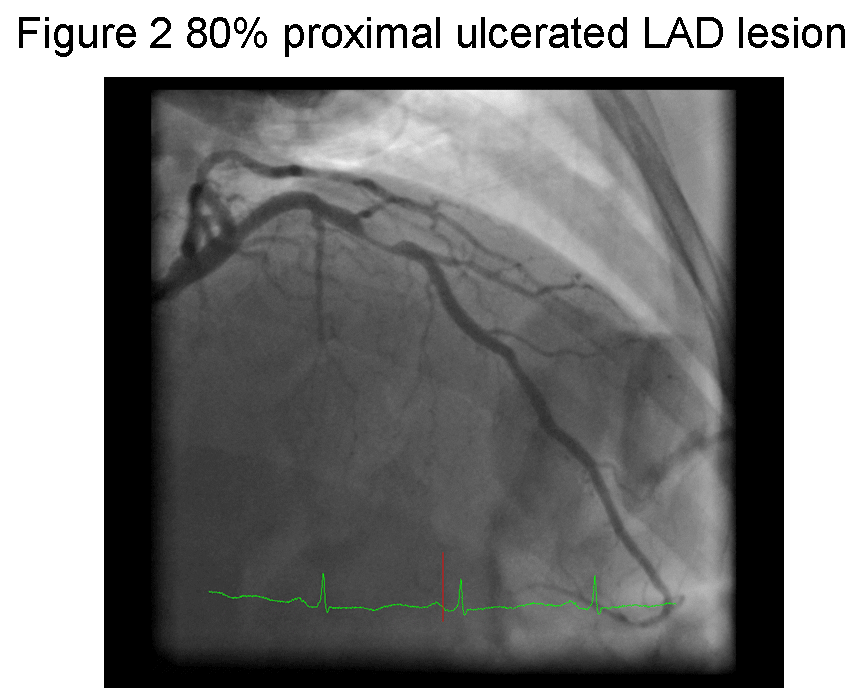 Figure 2: 80% proximal ulcerated LAD lesion