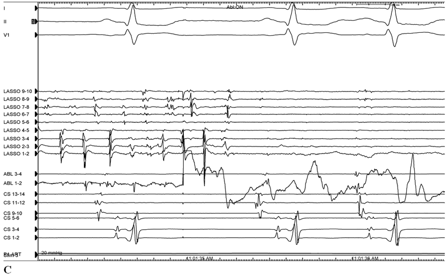 Figure 2C:A 71-Year-Old Man With Recurrent AFib After Prior Ablation
