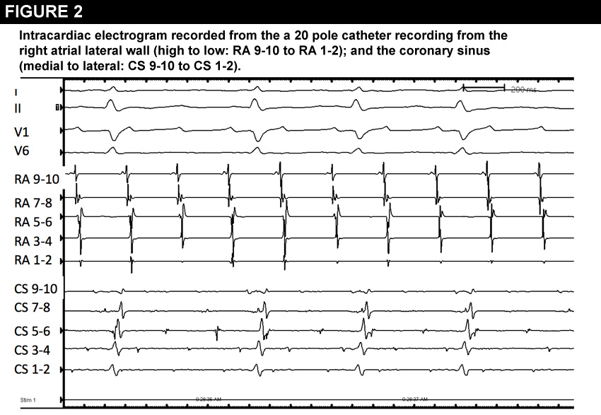 Figure 2: Systemic AL Amyloid and Recurrent Tachycardia