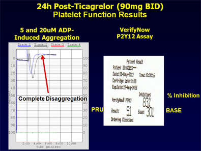 Figure 3: 24h Post-Ticagrelor (90mg BID) Platelet Function Results